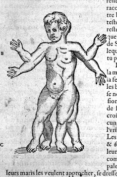 figure with four arms and legs' in 'A. Pare: "Oeuvres...", 1579: . Credit: Wellcome Collection.